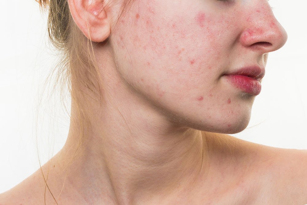 Dry Skin and Acne? They can co-exist. What to use?
